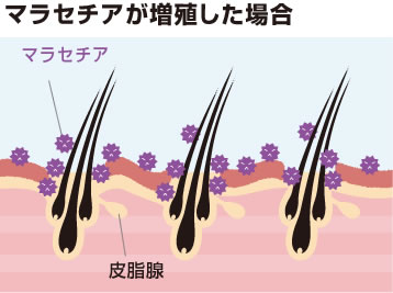 マラセチアが増殖した場合